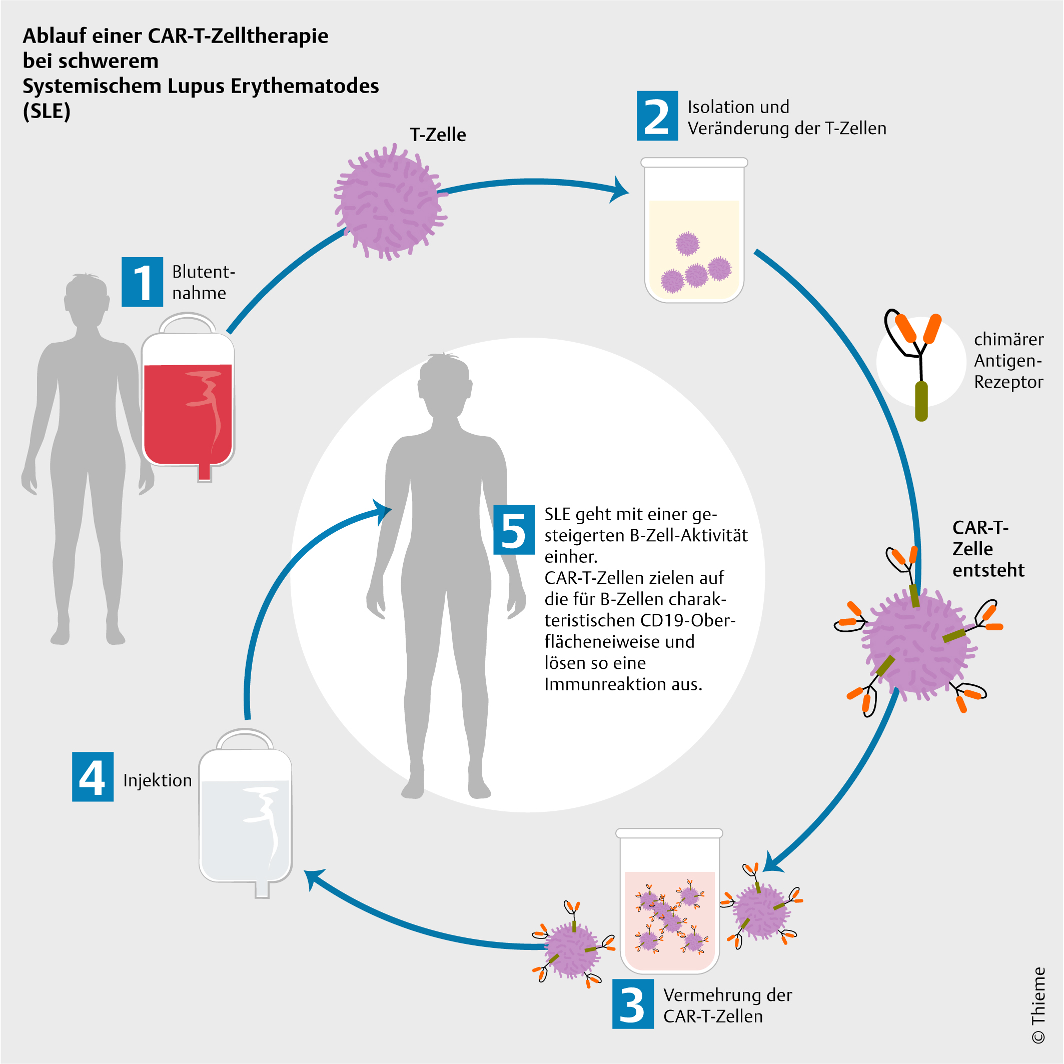 T-Zellen-Therapie bei Colitis ulcerosa